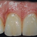 Before Photo of All on 4 Treatment