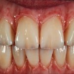 Before All on 4 Treatment  