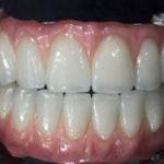 A maxillary porcelain hybrid bridge