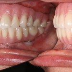 Side Angle Photo of All on 4 Treatment 
