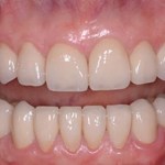 After Photo of All on 4 Treatment