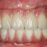 A maxillary porcelain hybrid bridge