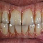 Before Photo of All on 4 Treatment Concept